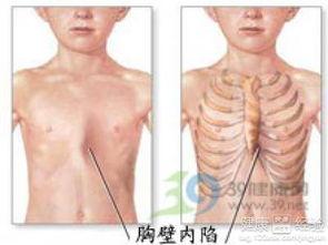 成人肋骨外翻视频讲解图,视频讲解图解与成因分析