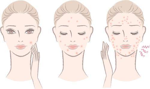 成人痘痘去除视频过程,跟我学专业祛痘视频教程