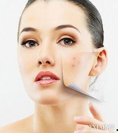 成人痘痘去除视频过程,跟我学专业祛痘视频教程