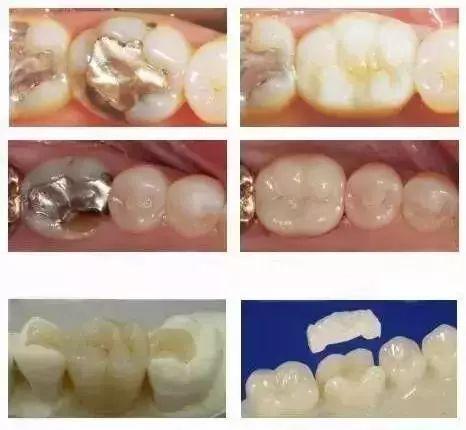 成人牙洞怎么补牙视频,成人牙洞补牙全流程视频解析