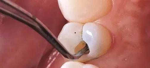 成人牙洞怎么补牙视频,成人牙洞补牙全流程视频解析
